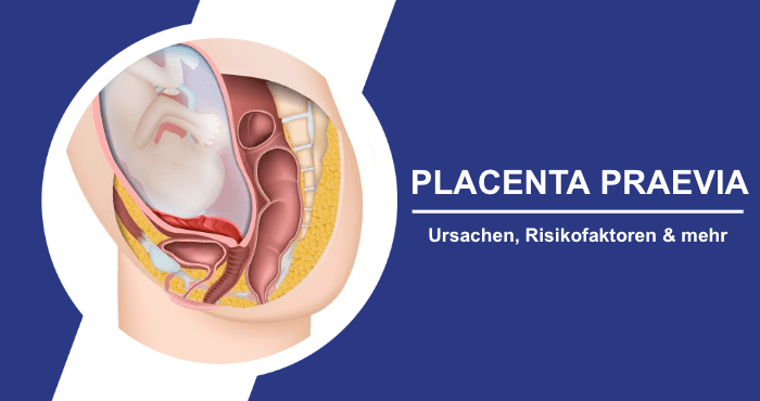 Placenta Praevia Ursachen Risikofaktoren Titelbild